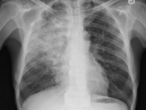 La Radiología ha sido el tercer pilar en el diagnóstico de la COVID-19