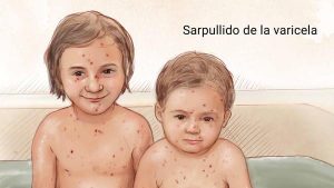 La varicela suele ser común en niños menores de 10 años.